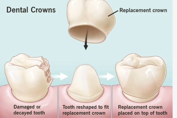 Dental Crowns