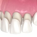 Porcelain Veneer