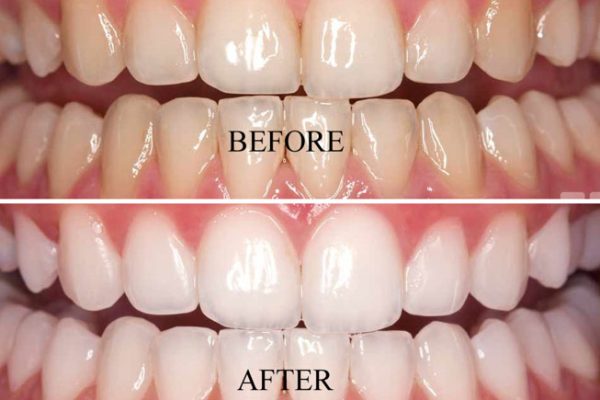 Tooth Whitening