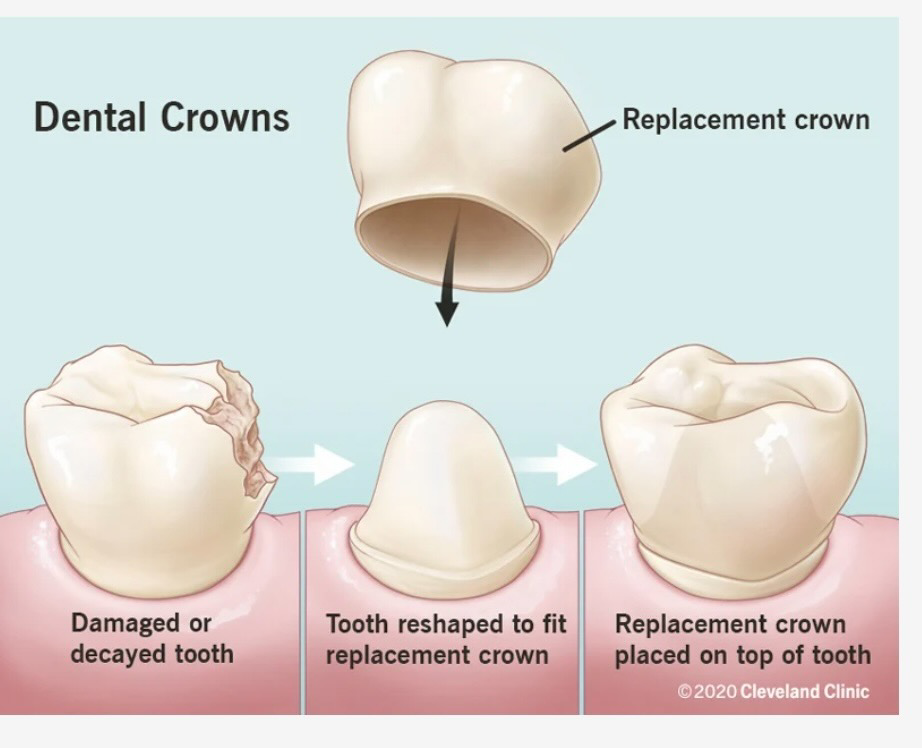 Dental Crowns