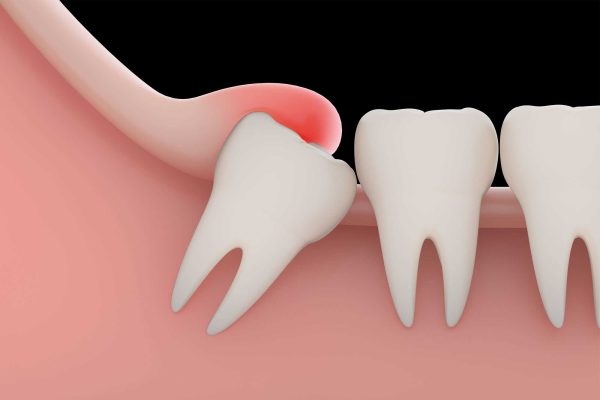 Wisdom Tooth Removal