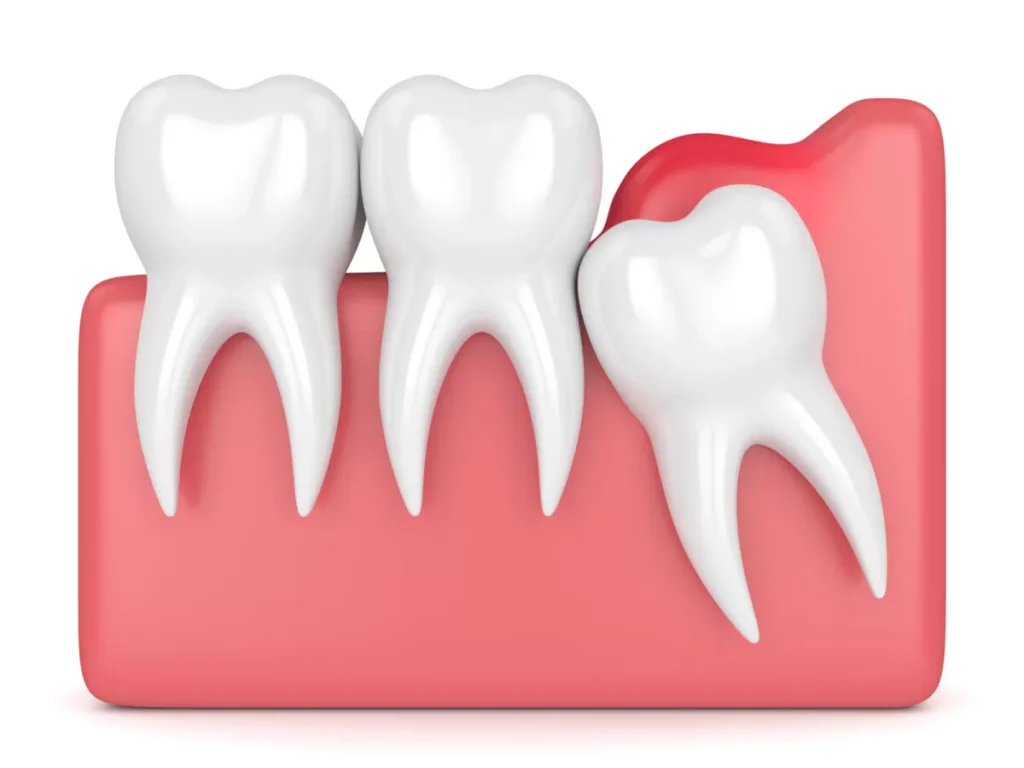 Pericoronitis