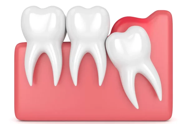 Pericoronitis