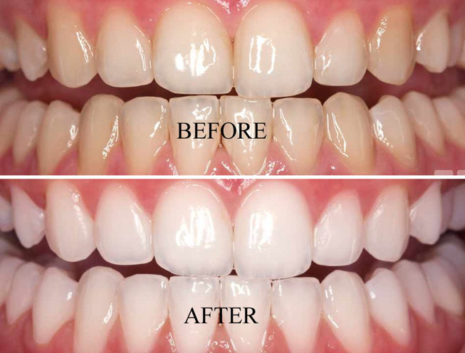 Tooth Whitening