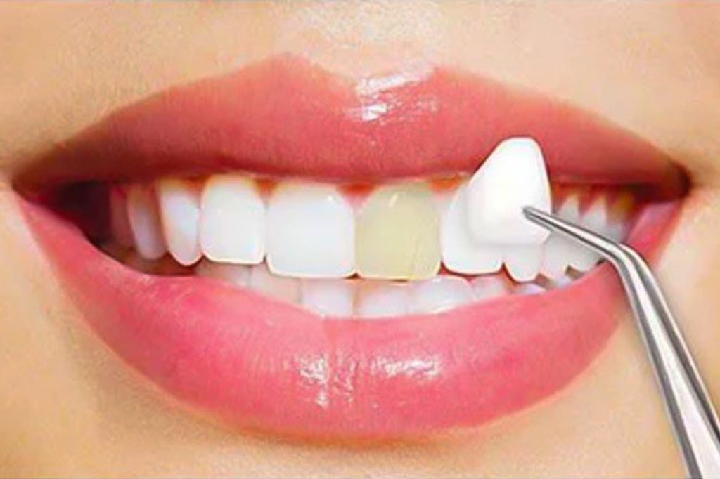 Porcelain Veneers